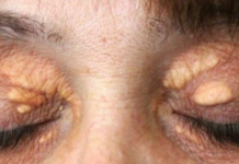 STAVILA SAM OVU NAMIRNICU NA MASNO TKIVO KOD OKA, ono je preko noći nestalo: EVO ŠTA ME SPASILO, SVI GA IMATE U KUĆI