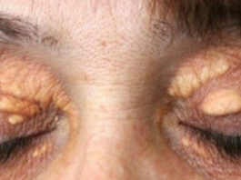 STAVILA SAM OVU NAMIRNICU NA MASNO TKIVO KOD OKA, ono je preko noći nestalo: EVO ŠTA ME SPASILO, SVI GA IMATE U KUĆI