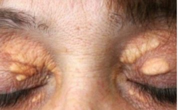 STAVILA SAM OVU NAMIRNICU NA MASNO TKIVO KOD OKA, ono je preko noći nestalo: EVO ŠTA ME SPASILO, SVI GA IMATE U KUĆI