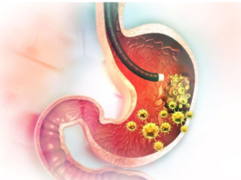 5 ranih simptoma raka želuca: Tumor može da raste godinama, a svi pacijenti prvo osjete ovo