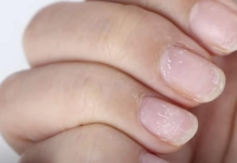 ZNAK ZA UZBUNU: Ako vidite OVO na vašim noktima idite doktoru odmah!