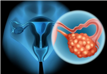 4 RANA SIMPTOMA RAKA JAJNIKA: Svaka žena ovo treba znati, JEDAN SIMPTOM NIKAKO NE SMIJETE IGNORISATI