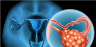 4 RANA SIMPTOMA RAKA JAJNIKA: Svaka žena ovo treba znati, JEDAN SIMPTOM NIKAKO NE SMIJETE IGNORISATI