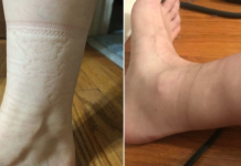 KAD SKINETE ČARAPE OSTANU VAM TRAGOVI NA NOGAMA: Evo šta se dešava sa vašim zdravljem