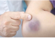 NIKAD NE BISTE POGODILI ZAŠTO SE MODRICE JAVLJAJU PO TIJELU: Nema Veze Sa POVREDAMA, PRAVI RAZLOG ĆE VAS ŠOKIRATI