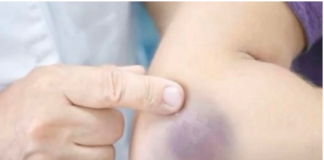 NIKAD NE BISTE POGODILI ZAŠTO SE MODRICE JAVLJAJU PO TIJELU: Nema Veze Sa POVREDAMA, PRAVI RAZLOG ĆE VAS ŠOKIRATI