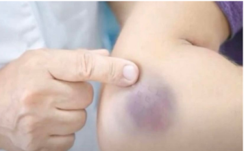 NIKAD NE BISTE POGODILI ZAŠTO SE MODRICE JAVLJAJU PO TIJELU: Nema Veze Sa POVREDAMA, PRAVI RAZLOG ĆE VAS ŠOKIRATI