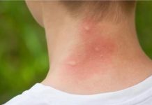 UJEO VAS JE KOMARAC, SAMO NAMAŽITE OVO: Svrab nestaje u sekundi, RIJEŠITE SE MUKE