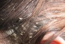 Imate li problema sa peruti? Ovo je najefikasnije i prirodno rješenje za kojim su svi poludjeli!