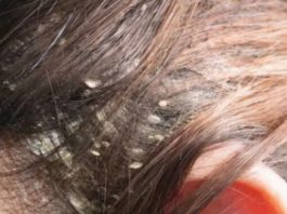 Imate li problema sa peruti? Ovo je najefikasnije i prirodno rješenje za kojim su svi poludjeli!