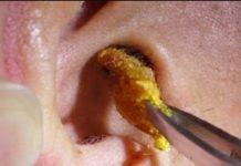 Ako imate previše voska u ušima I svrbi vas uho? Doktor otkriva kako da izbacite sav vosak jednostavno I bezbolno, ne trebaju vam štapićI za ušI