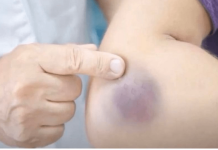 NIKAD NE BISTE POGODILI ZAŠTO SE MODRICE JAVLJAJU PO TIJELU: Nema Veze Sa POVREDAMA, PRAVI RAZLOG ĆE VAS ŠOKIRATI