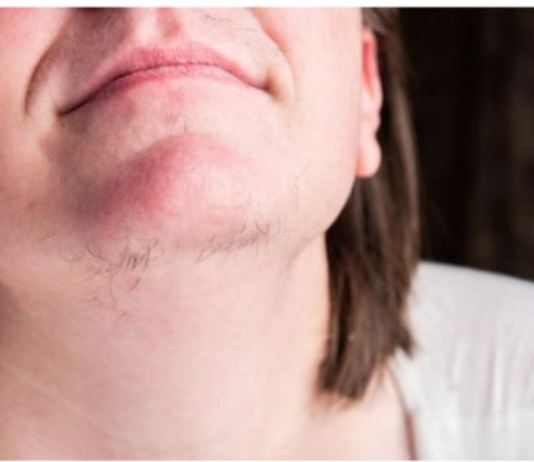 EVO ZAŠTO ŽENE IMAJU DLAKAVU BRADU! Ovo vam organizam govori!