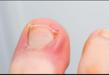 PAZITE SE! Ako nokti pokažu ovaj znak, idite odmah kod ljekara: Upozorenje na PROBLEM koji može biti OZBILJAN