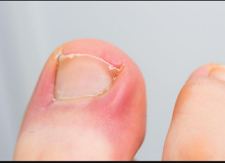 PAZITE SE! Ako nokti pokažu ovaj znak, idite odmah kod ljekara: Upozorenje na PROBLEM koji može biti OZBILJAN