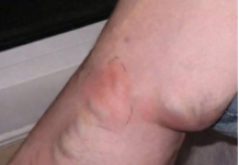 OVE SIMPTOME NIKAKO NE IGNORIŠITE! To je znak da se u tijelu formira TROMB opasan po ŽIVOT