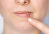 Kada herpes prestaje biti zarazan? Evo što treba znati