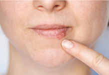 Kada herpes prestaje biti zarazan? Evo što treba znati