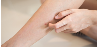 „Šta uzrokuje svrab na različitim dijelovima tijela: kada je bezopasan, a kada potražiti savjet ljekara“