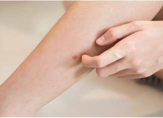 „Šta uzrokuje svrab na različitim dijelovima tijela: kada je bezopasan, a kada potražiti savjet ljekara“