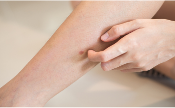 „Šta uzrokuje svrab na različitim dijelovima tijela: kada je bezopasan, a kada potražiti savjet ljekara“