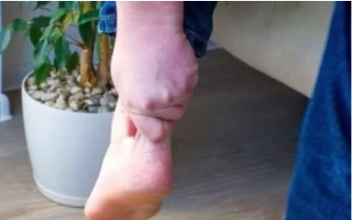 3 ZNAKA VISOKOG HOLESTEROLA: Odmah pogledajte vaše ruke i noge