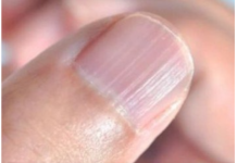 IMATE LI OVAKVE IZBOČINE NA NOKTIMA – evo šta one znače: Doktorica otkrila i možda ćete se iznenaditi