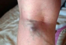 NAMIRNICE KOJE POVEĆAVAJU RIZIK OD TROMBOZE, JEDNA POSEBNO: Jedemo ih svakoga dana, a štete arterijama