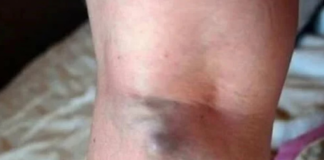 NAMIRNICE KOJE POVEĆAVAJU RIZIK OD TROMBOZE, JEDNA POSEBNO: Jedemo ih svakoga dana, a štete arterijama