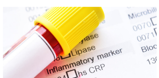 Šta znači povišen crp? Evo šta kaže doktorica, upozorenje: 2 važne stvari ljudi nemaju u kući…
